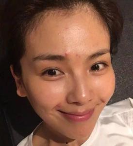 明星素颜痘,揭秘明星护肤背后的战“痘”故事